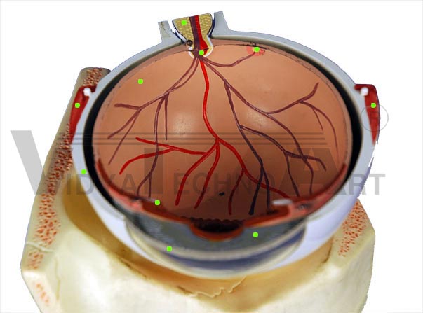 Eye: Optic Nerve