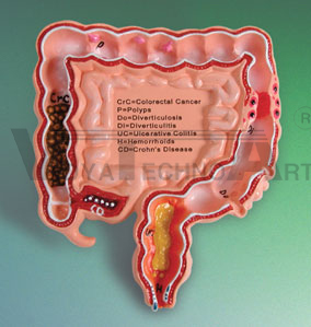 Pocket Colon Disorder