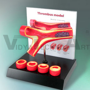 Thrombus Model | Cardiovascular Models