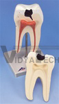 Lower Twin-Root Molar Showing Caries Attack, 2 Part | Dental Models