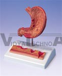 Stomach With Ulcers | Digestive Models