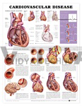 Cardiovascular Disease Anatomical Chart | Heart Charts