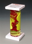 Occluded Artery Model | Heart Models