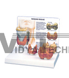 The Model Of Hypothyroid Pathology | Medical Promotional Model